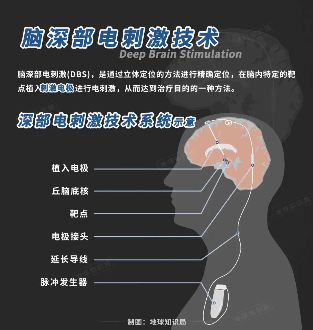 宣战马斯克！奥特曼进军脑机接口